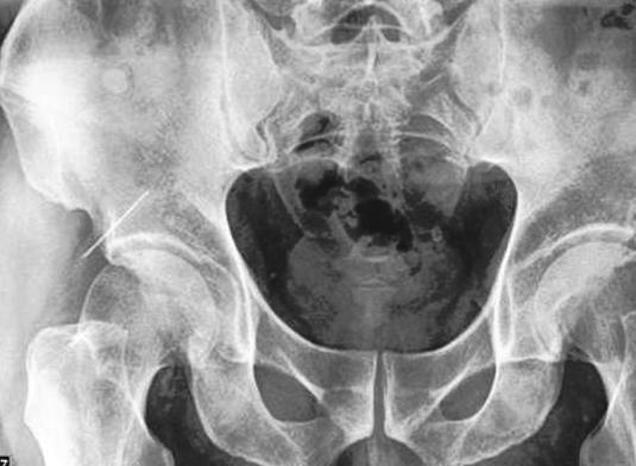 A nap egészségügyi horrorsztorija Dénesé