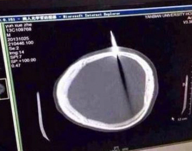 Illustration for article titled Huh ez nem halloween, egy fószer késsel a fejében sétált be a korházba