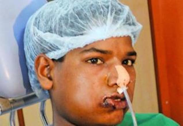 Illustration for article titled 232 fogát húzták ki egy indiai fiúnak