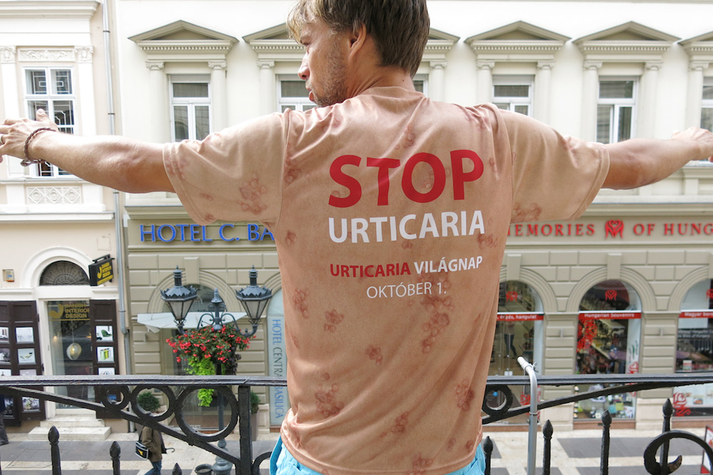 Ragyás az arca? Hozd szóba nyugodtan!